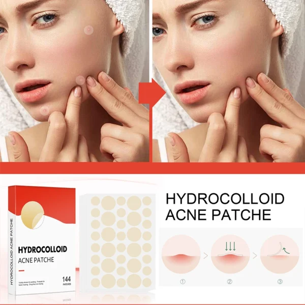144pcs Acne Patch Set - Invisible Spot Stickers for All Skin Types - Image 2